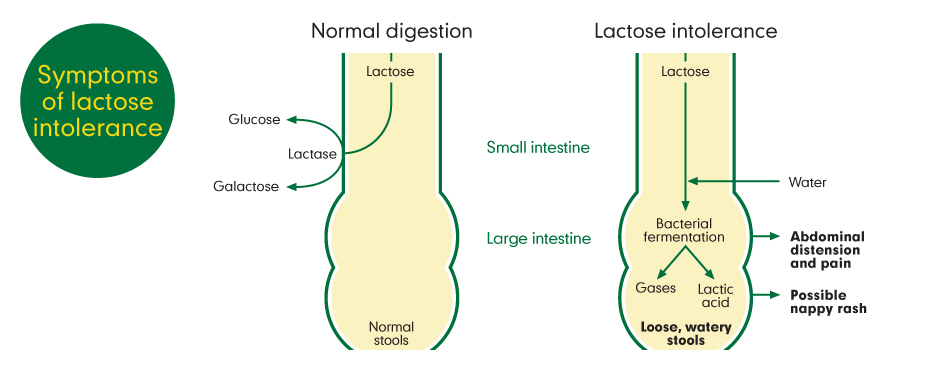 Are you sure it’s lactose intolerance and not delayed cow’s milk allergy?